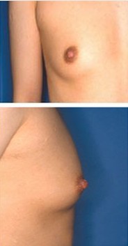 乳头缩小整形手术的案例