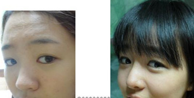 有图有真相 女子隆鼻后收获精美鼻型
