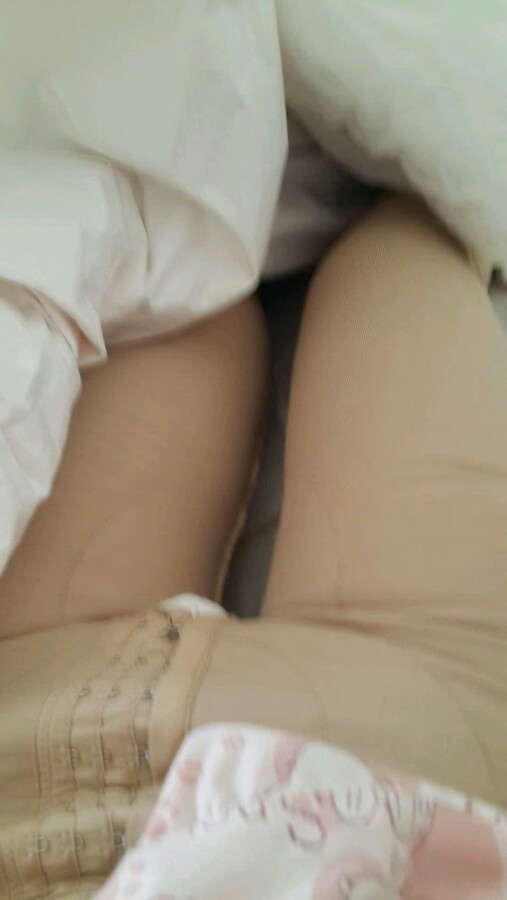 大腿吸脂手术的案例