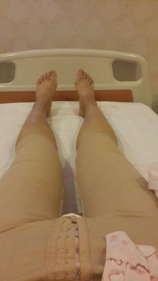 大腿吸脂手术的案例