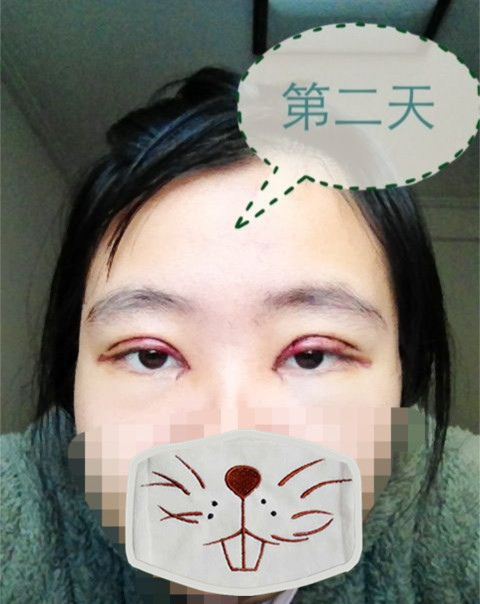 双眼皮手术的真实案例