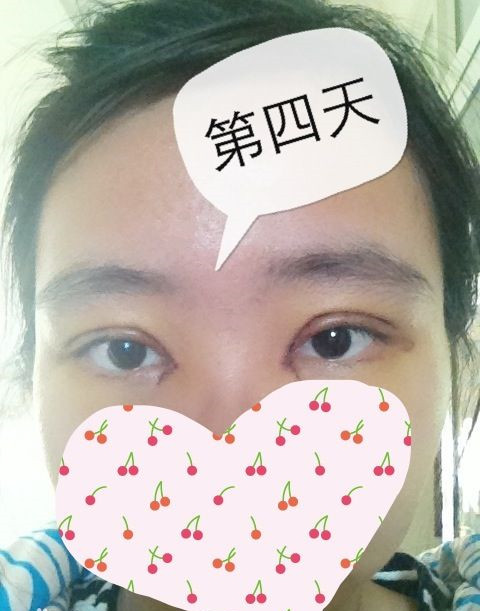 双眼皮手术的真实案例