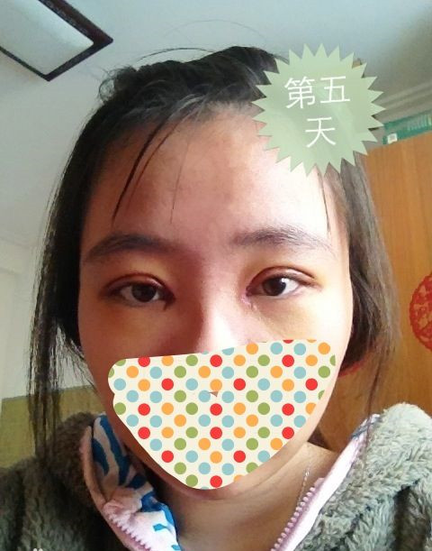 双眼皮手术的真实案例