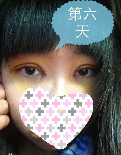双眼皮手术的真实案例