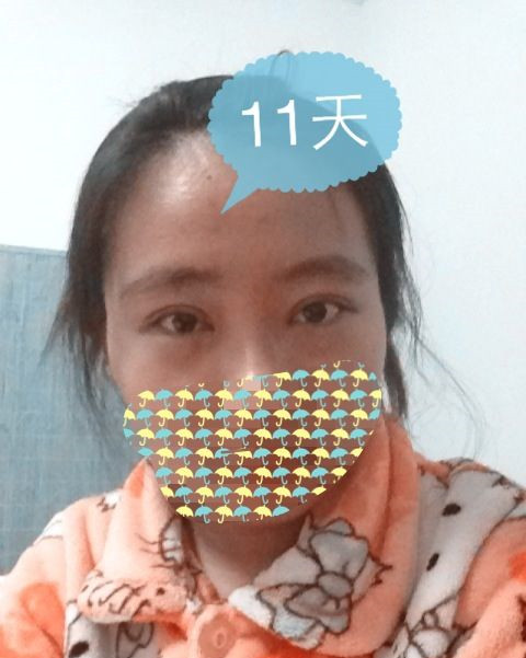 双眼皮手术的真实案例
