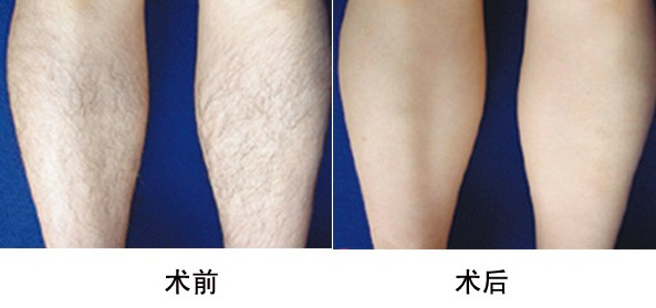 小腿脱毛