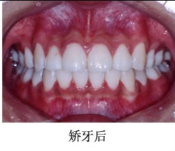 牙齿矫正