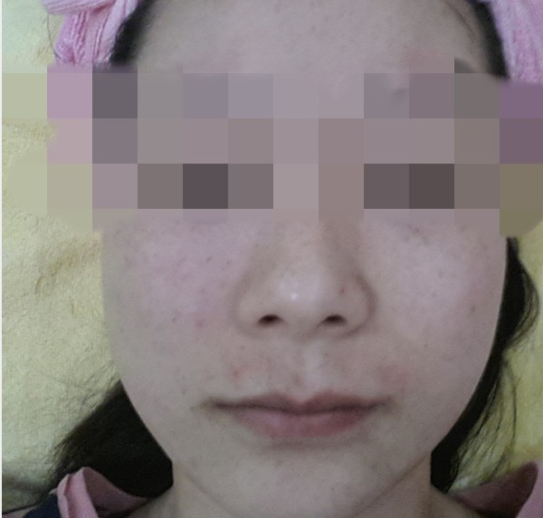 激光祛斑手术的案例