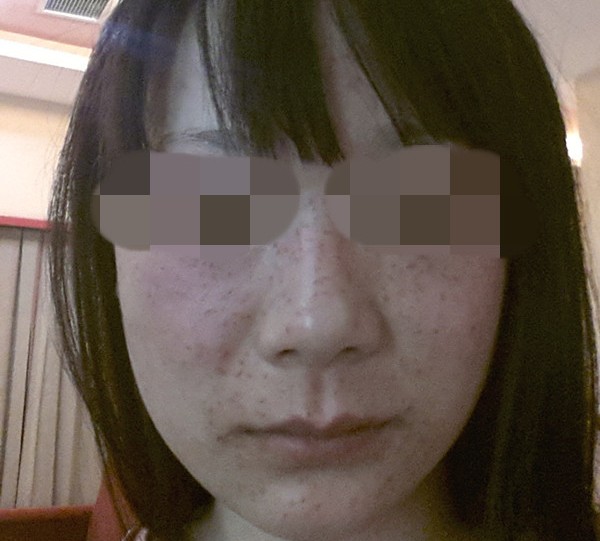 激光祛斑手术的案例
