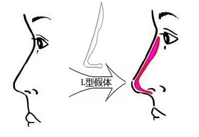 假体隆鼻