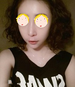鹰钩鼻矫正的案例