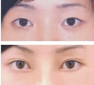 压双眼皮术前术后照片